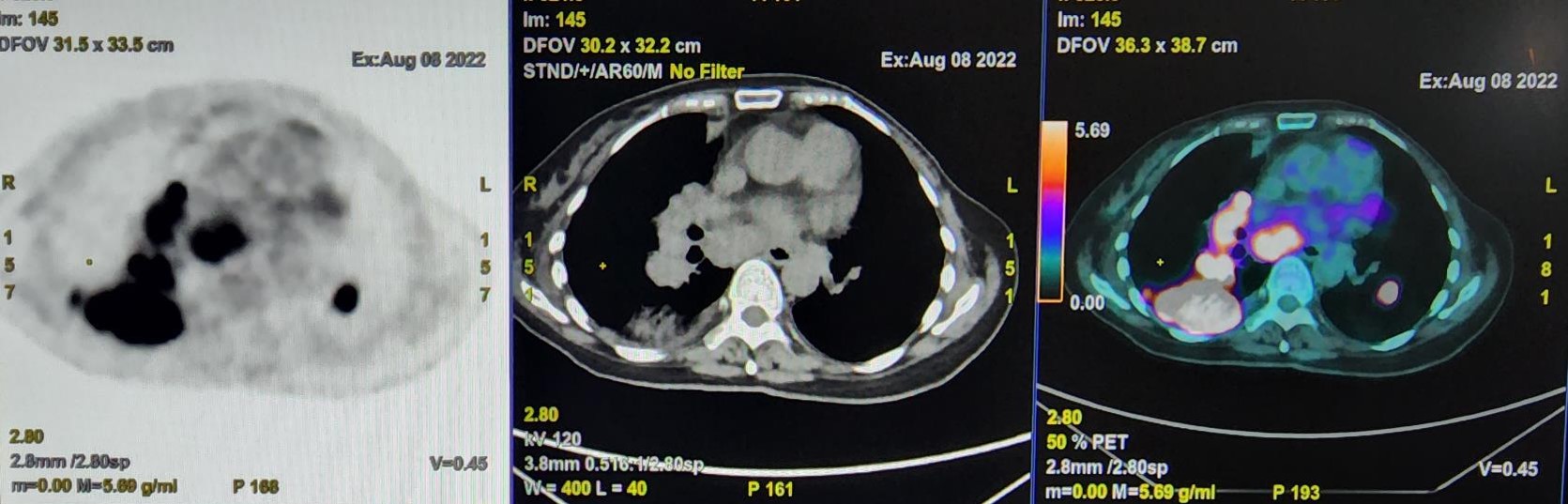 Digital PET/CT Scans for Better Imaging in Nuclear Medicine for Cancer